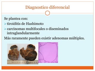 Diagnostico diferencial
Se plantea con:
tiroiditis de Hashimoto
carcinomas multifocales o diseminados
intraglandularmente
Más raramente pueden existir adenomas múltiples.
 