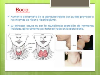 Bocio:
 Aumento del tamaño de la glándula tiroides que puede provocar o
no síntomas de hiper o hipotiroidismo.
 Su principal causa es por la insuficiencia secreción de hormonas
tiroideas, generalmente por falta de yodo en la dieta diaria.
 