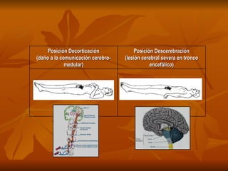 Posición Decorticación (daño a la comunicación cerebro-medular) Posición Descerebración (lesión cerebral severa en tronco encefálico) 