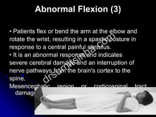 Abnormal Flexion (3)
• Patients flex or bend the arm at the elbow and
rotate the wrist, resulting in a spastic posture in
response to a central painful stimulus.
• It is an abnormal response and indicates
severe cerebral damage and an interruption of
nerve pathways from the brain's cortex to the
spine.
Mesencephalic region or corticospinal tract
damage
 