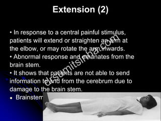 Extension (2)
• In response to a central painful stimulus,
patients will extend or straighten an arm at
the elbow, or may rotate the arm inwards.
• Abnormal response and emanates from the
brain stem.
• It shows that patients are not able to send
information to and from the cerebrum due to
damage to the brain stem.
● Brainstem damage below the red nucleus
 