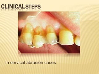 CLINICALSTEPS
In cervical abrasion cases
 