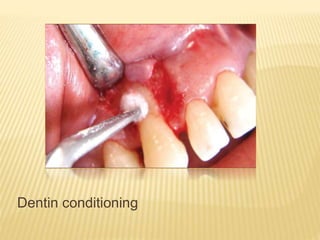 Dentin conditioning
 