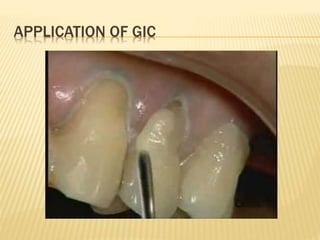 APPLICATION OF GIC
 
