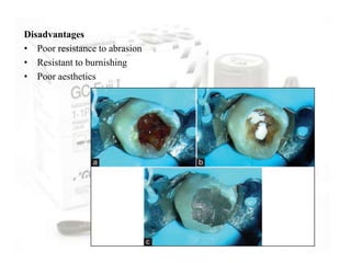 Disadvantages
• Poor resistance to abrasion
• Resistant to burnishing
• Poor aesthetics
 