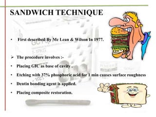 • First described By Mc Lean & Wilson In 1977.
 The procedure involves :-
• Placing GIC as base of cavity .
• Etching with 37% phosphoric acid for 1 min causes surface roughness
• Dentin bonding agent is applied.
• Placing composite restoration.
SANDWICH TECHNIQUE
 