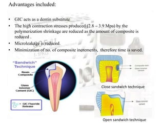 Advantages included:
• GIC acts as a dentin substitute
• The high contraction stresses produced (2.8 – 3.9 Mpa) by the
polymerization shrinkage are reduced as the amount of composite is
reduced .
• Microleakage is reduced.
• Minimization of no. of composite increments, therefore time is saved.
Close sandwich technique
Open sandwich technique
 