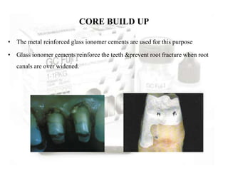 • The metal reinforced glass ionomer cements are used for this purpose
• Glass ionomer cements reinforce the teeth &prevent root fracture when root
canals are over widened.
CORE BUILD UP
 