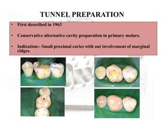 TUNNEL PREPARATION
• First described in 1963
• Conservative alternative cavity preparation in primary molars.
• Indication:- Small proximal caries with out involvement of marginal
ridges.
 