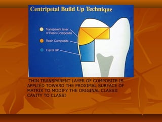 THIN TRANSPARENT LAYER OF COMPOSITE IS
APPLIED TOWARD THE PROXIMAL SURFACE OF
MATRIX TO MODIFY THE ORIGINAL CLASSII
CAVITY TO CLASSI
 