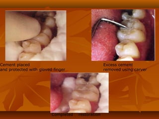 Cement placed
and protected with gloved finger
Excess cement
removed using carver
Completed restoration
 