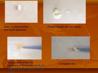 Glass ionomer powder
and liquid dispensed
Powder divided into two halves
Incorporation of the first
increment of the powder gently butgently but
rapidly rolling the powder into therapidly rolling the powder into the
liquidliquid
Completed mix
 