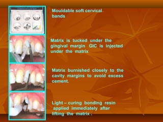 Mouldable soft cervical
bands
Matrix is tucked under the
gingival margin GIC is injected
under the matrix
Matrix burnished closely to the
cavity margins to avoid excess
cement.
Light – curing bonding resin
applied immediately after
lifting the matrix .
 