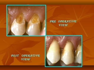 PRE OPERATIVE
VIEW
POST OPERATIVE
VIEW
 