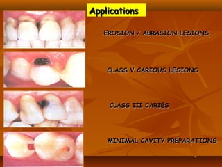 ApplicationsApplications
EROSION / ABRASION LESIONSEROSION / ABRASION LESIONS
CLASS III CARIESCLASS III CARIES
MINIMAL CAVITY PREPARATIONSMINIMAL CAVITY PREPARATIONS
CLASS V CARIOUS LESIONSCLASS V CARIOUS LESIONS
 