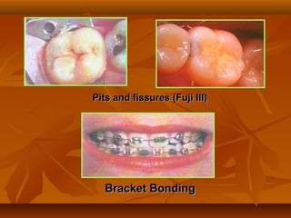 Pits and fissures (Fuji III)Pits and fissures (Fuji III)
Bracket BondingBracket Bonding
 