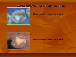 GLASS IONOMER AS LINER AND BASEGLASS IONOMER AS LINER AND BASE
Glass-ionomer cement as a lining.
Glass-ionomer cement as a base.
 