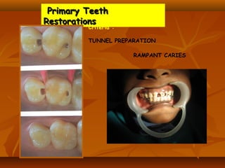 Primary TeethPrimary Teeth
RestorationsRestorations
Criteria :
TUNNEL PREPARATION
RAMPANT CARIES
 