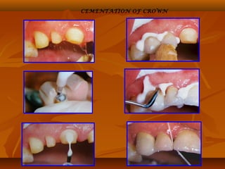 CEMENTATION OF CROWN
 