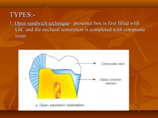TYPES:-TYPES:-
1.1. Open sandwich techniqueOpen sandwich technique- proximal box is first filled with- proximal box is first filled with
GIC and the occlusal restoration is completed with compositeGIC and the occlusal restoration is completed with composite
resin.resin.
 