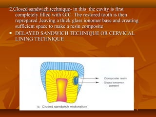 2.2.Closed sandwich techniqueClosed sandwich technique- in this the cavity is first- in this the cavity is first
completely filled with GIC. The restored tooth is thencompletely filled with GIC. The restored tooth is then
reprepared ,leaving a thick glass ionomer base and creatingreprepared ,leaving a thick glass ionomer base and creating
sufficient space to make a resin compositesufficient space to make a resin composite
 DELAYED SANDWICH TECHNIQUE OR CERVICALDELAYED SANDWICH TECHNIQUE OR CERVICAL
LINING TECHNIQUELINING TECHNIQUE
 