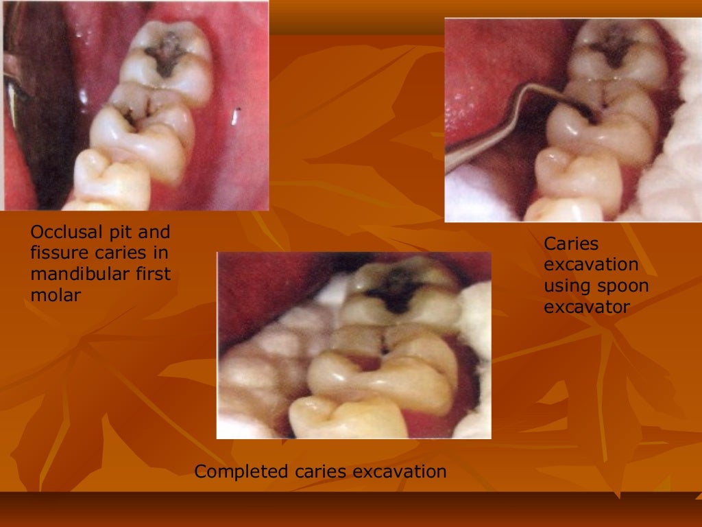 Glass ionomer cement