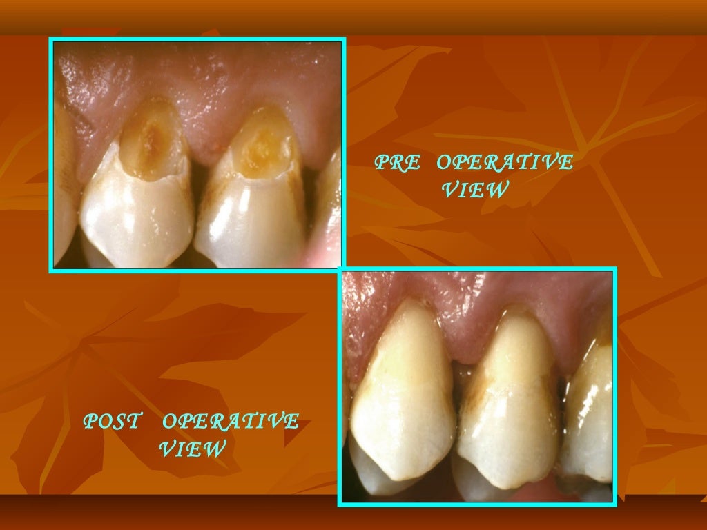 Glass ionomer cement