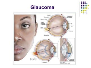 Glaucoma 