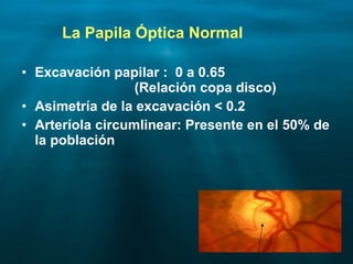 Glaucoma Slide 27