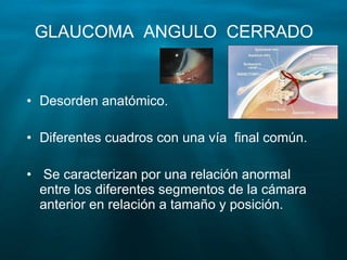Glaucoma Slide 57