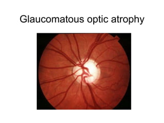 Glaucomatous optic atrophy 