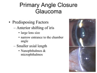 Predisposing Factors Anterior shifting of iris large lens size narrow entrance to the chamber angle Smaller axial length Nanophthalmos & microphthalmos Primary Angle Closure Glaucoma 