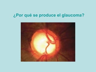 ¿Por qué se produce el glaucoma?   