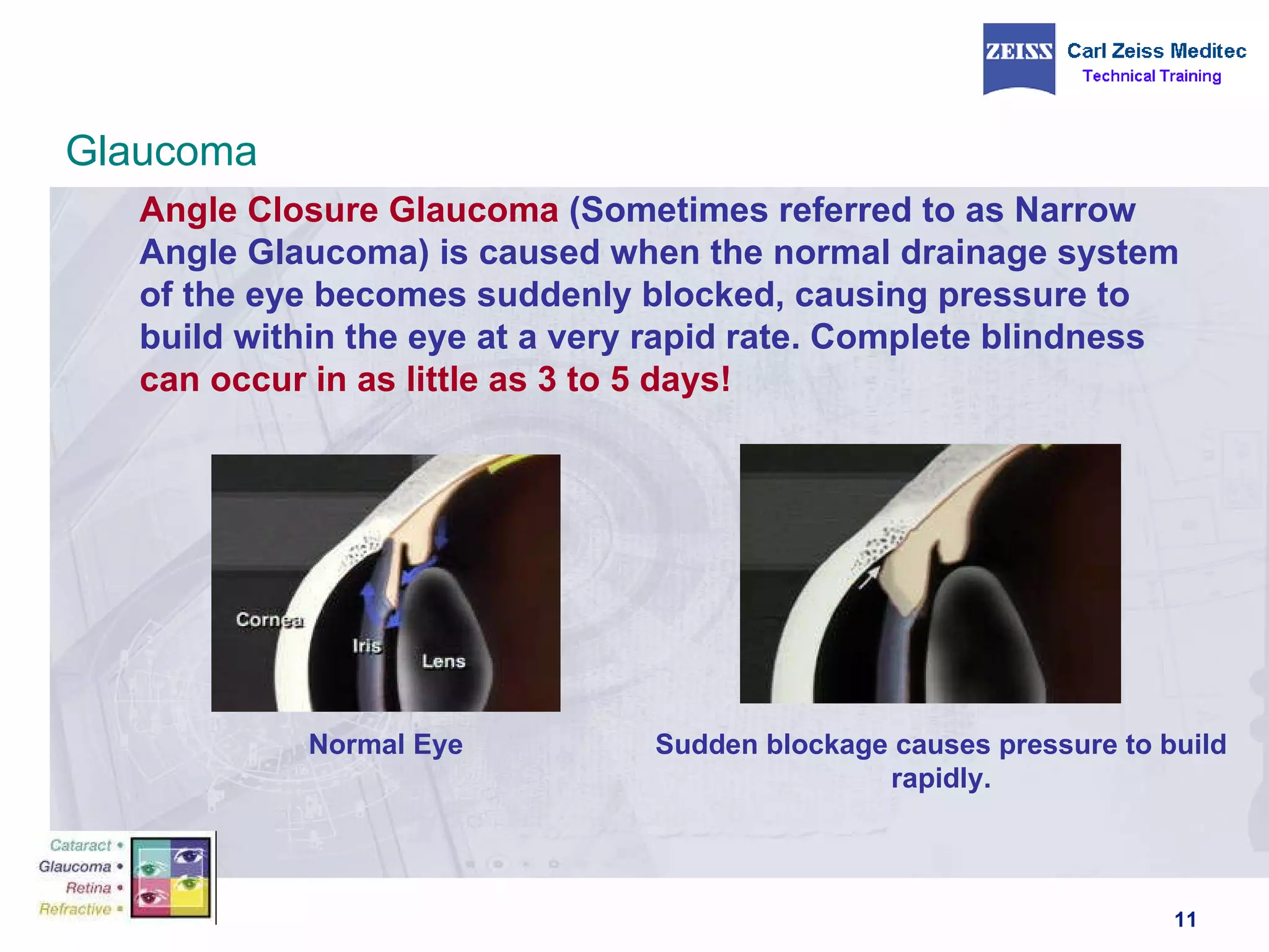 Angle Closure Glaucoma  (Sometimes referred to as Narrow   Angle Glaucoma) is caused when the normal drainage system of the eye becomes suddenly blocked, causing pressure to build within the eye at a very rapid rate. Complete blindness  can occur in as little as 3 to 5 days! Normal Eye Sudden blockage causes pressure to build rapidly. Glaucoma 