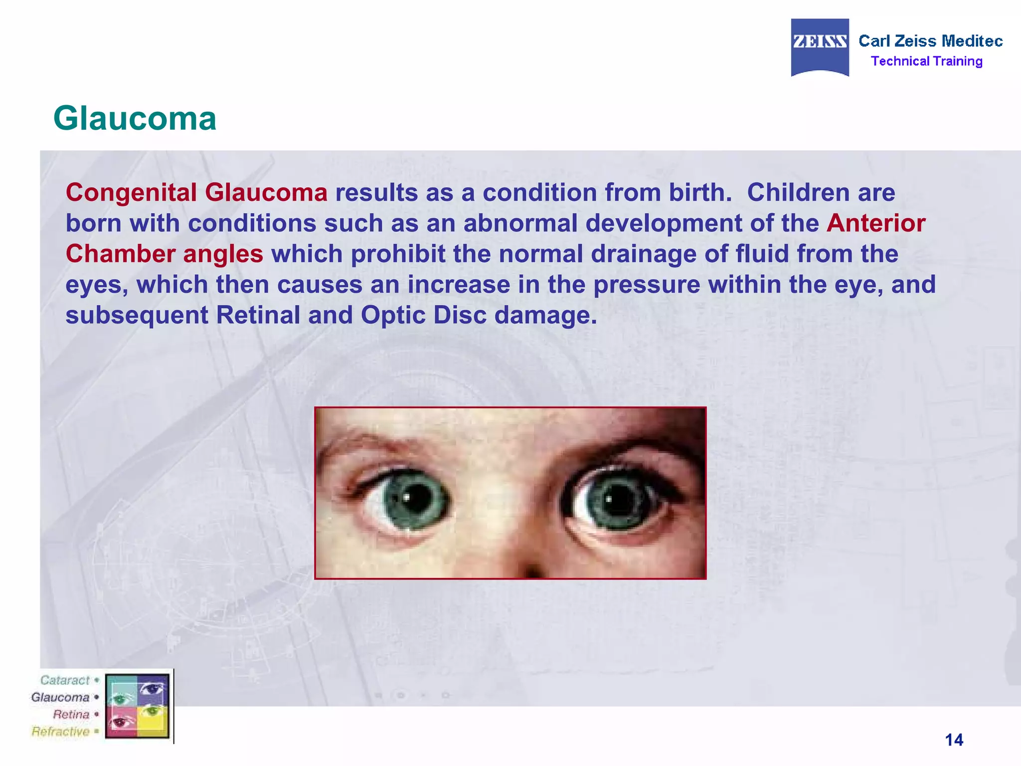 Glaucoma Congenital Glaucoma  results as a condition from birth.  Children are born with conditions such as an abnormal development of the  Anterior   Chamber angles  which prohibit the normal drainage of fluid from the eyes, which then causes an increase in the pressure within the eye, and subsequent Retinal and Optic Disc damage. 