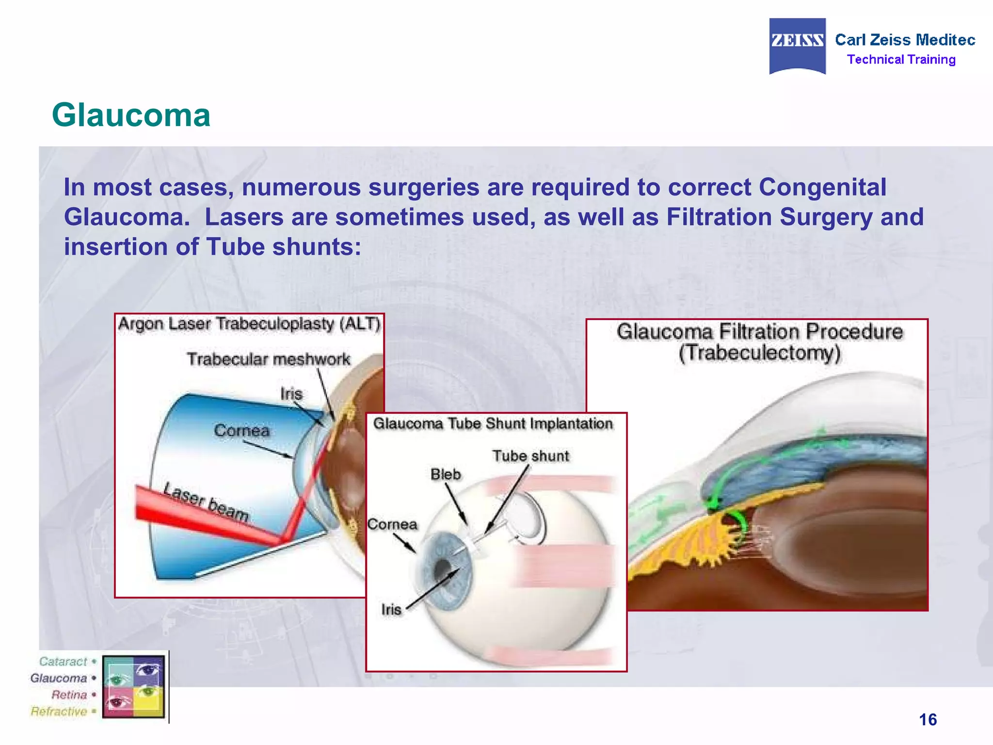 Glaucoma In most cases, numerous surgeries are required to correct Congenital Glaucoma.  Lasers are sometimes used, as well as Filtration Surgery and insertion of Tube shunts: 