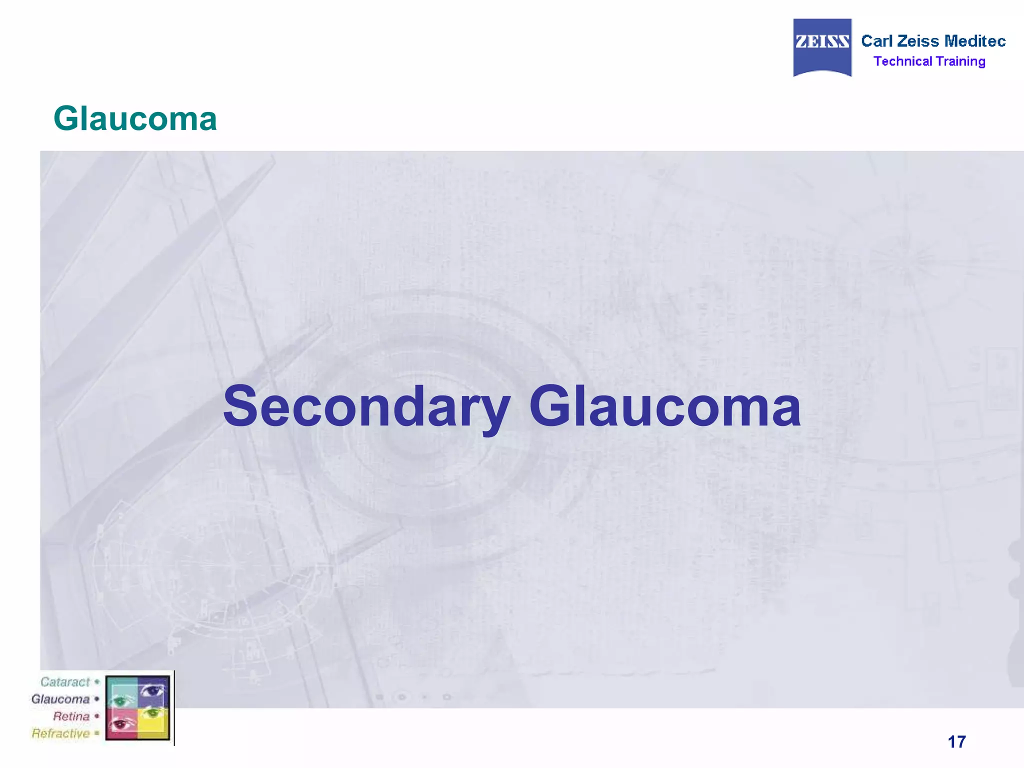 Glaucoma Secondary Glaucoma  