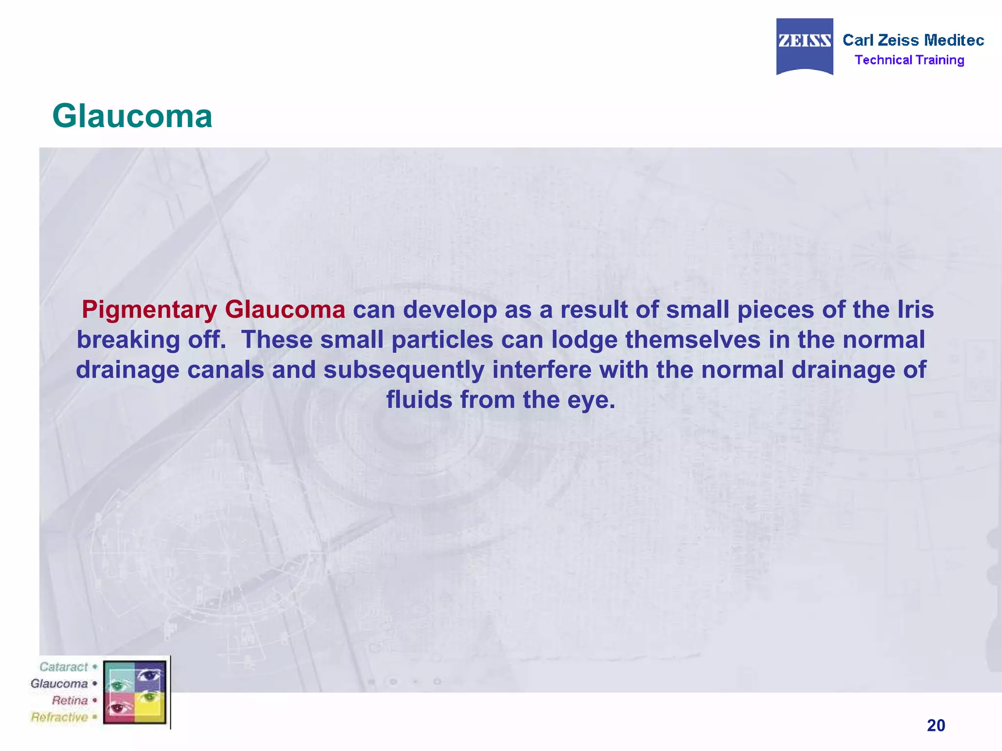 Glaucoma Pigmentary Glaucoma  can develop as a result of small pieces of the Iris breaking off.  These small particles can lodge themselves in the normal drainage canals and subsequently interfere with the normal drainage of fluids from the eye. 