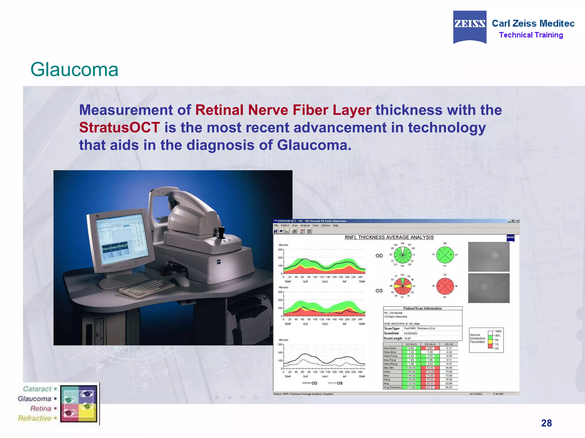 Measurement of  Retinal Nerve Fiber Layer  thickness with the  StratusOCT  is the most recent advancement in technology that aids in the diagnosis of Glaucoma. Glaucoma 