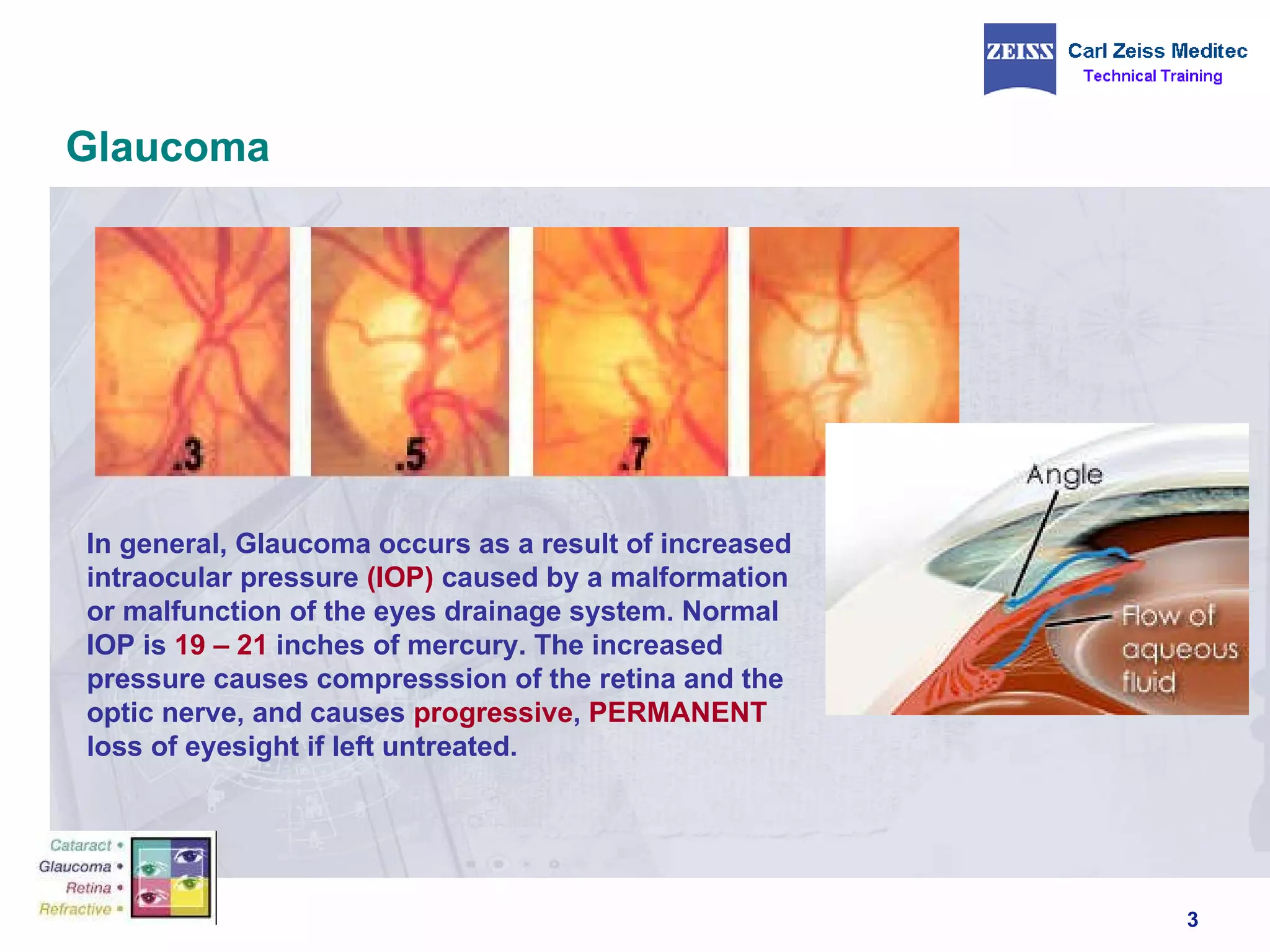 Glaucoma In general, Glaucoma occurs as a result of increased intraocular pressure  (IOP)  caused by a malformation or malfunction of the eyes drainage system. Normal IOP is  19 – 21  inches of mercury. The increased pressure causes compresssion of the retina and the optic nerve, and causes  progressive ,  PERMANENT  loss of eyesight if left untreated. 