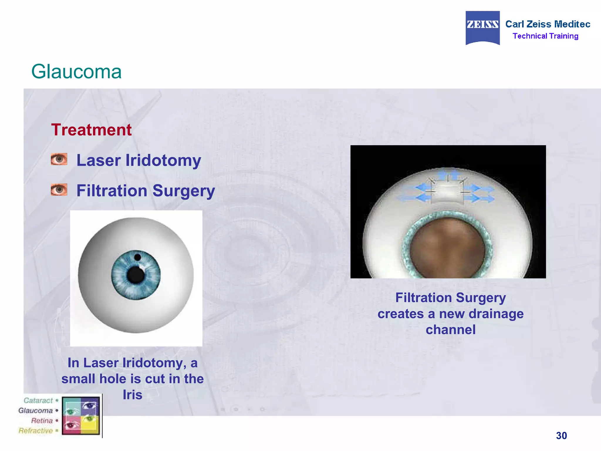 Treatment Laser Iridotomy Filtration Surgery In Laser Iridotomy, a small hole is cut in the Iris Filtration Surgery creates a new drainage channel Glaucoma 