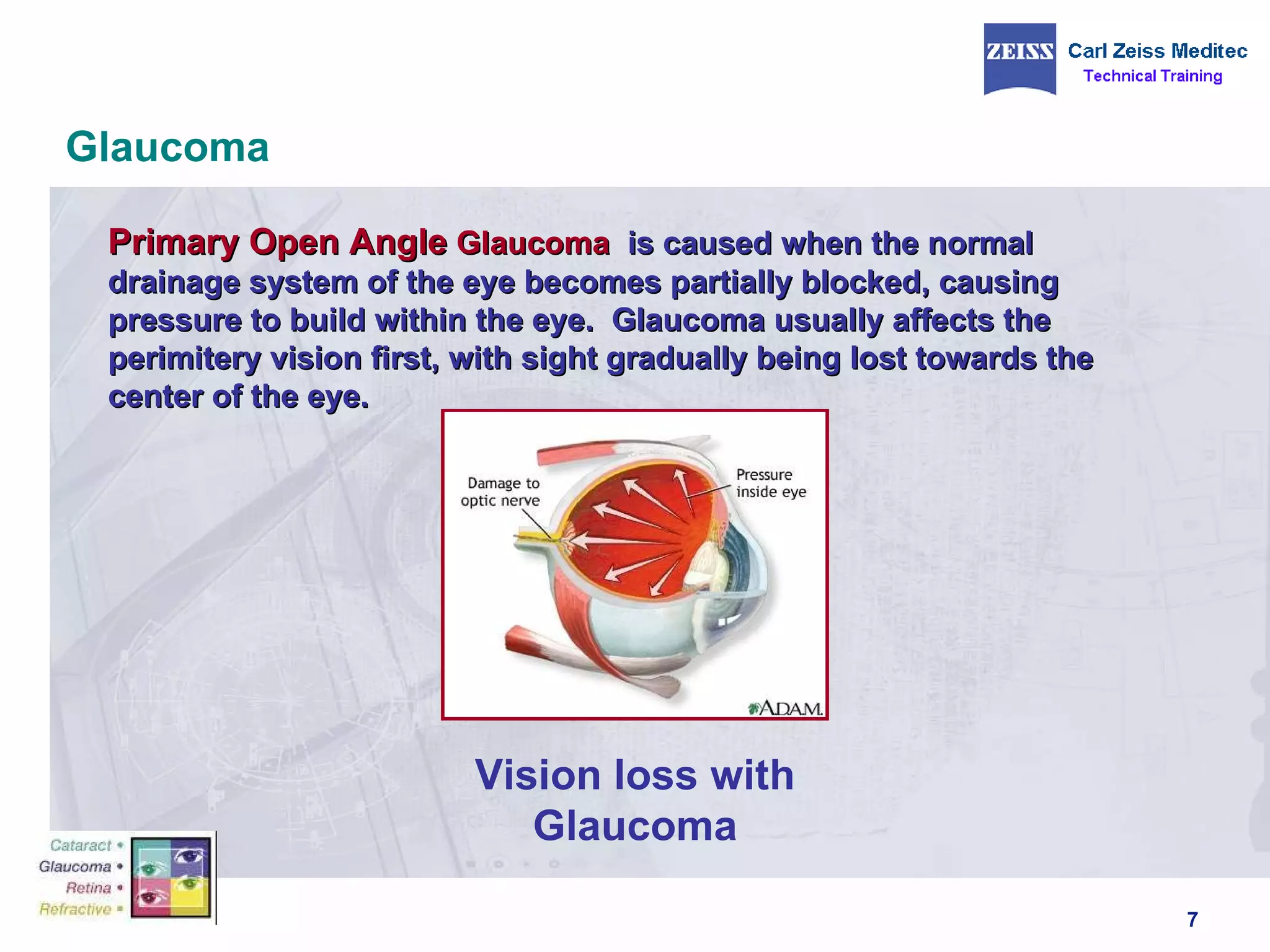Glaucoma Primary Open Angle  Glaucoma   is caused when the normal drainage system of the eye becomes partially blocked, causing pressure to build within the eye.  Glaucoma usually affects the perimitery vision first, with sight gradually being lost towards the center of the eye.  Vision loss with Glaucoma 