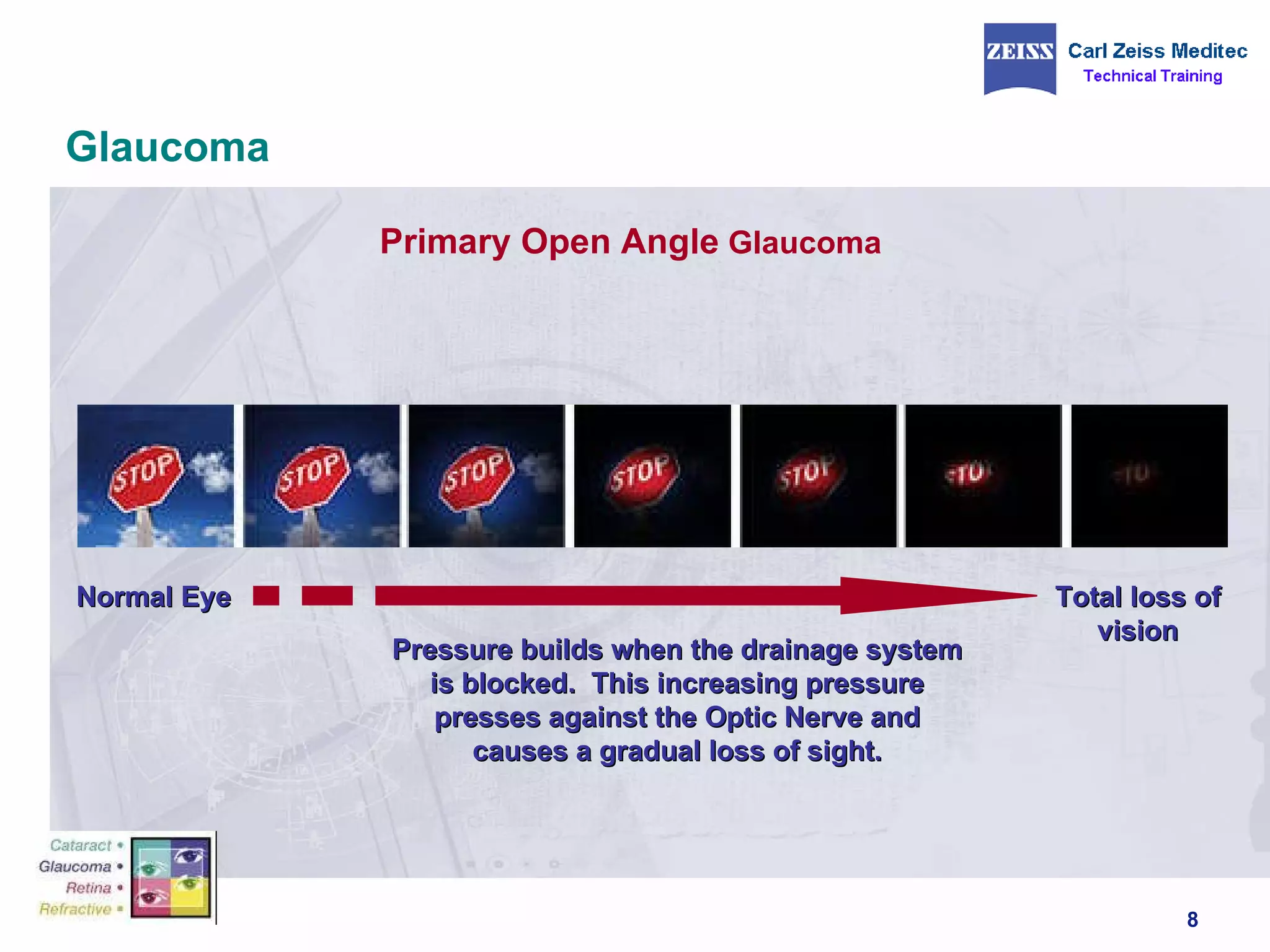 Glaucoma Primary Open Angle  Glaucoma   Normal Eye Pressure builds when the drainage system is blocked.  This increasing pressure presses against the Optic Nerve and causes a gradual loss of sight. Total loss of vision 