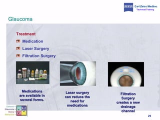 Treatment Medication Laser Surgery Filtration Surgery Medications are available in several forms. Laser surgery can reduce the need for medications Filtration Surgery creates a new drainage channel Glaucoma 