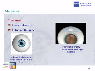 Treatment Laser Iridotomy Filtration Surgery In Laser Iridotomy, a small hole is cut in the Iris Filtration Surgery creates a new drainage channel Glaucoma 