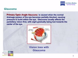 Glaucoma Primary Open Angle  Glaucoma   is caused when the normal drainage system of the eye becomes partially blocked, causing pressure to build within the eye.  Glaucoma usually affects the perimitery vision first, with sight gradually being lost towards the center of the eye.  Vision loss with Glaucoma 