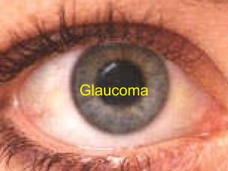 Glaucoma The silent thief of sight 