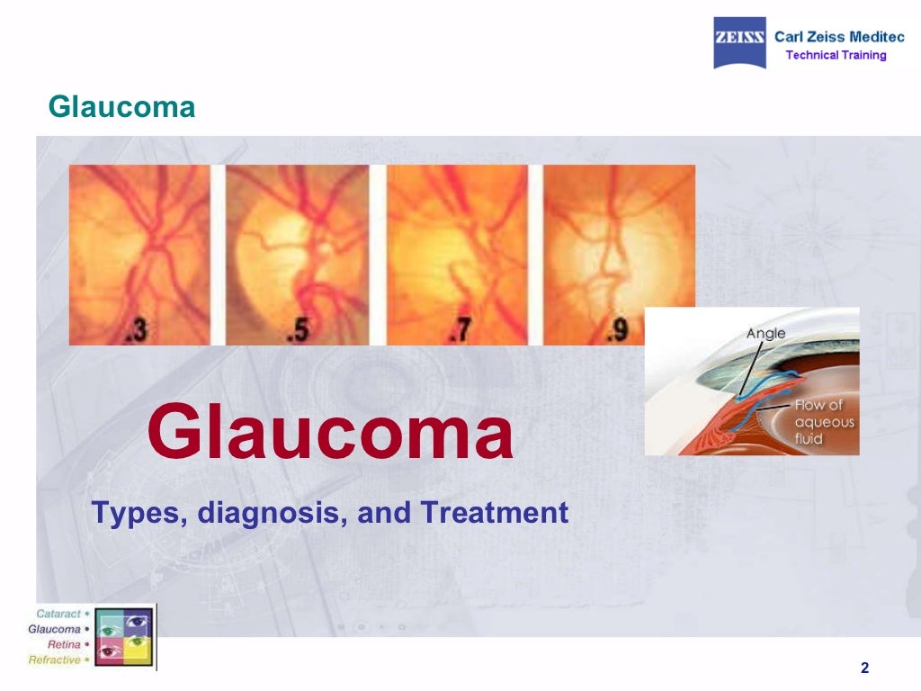 case study on glaucoma slideshare