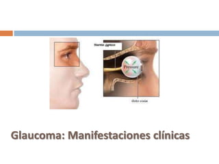 Glaucoma: Manifestaciones clínicas
 