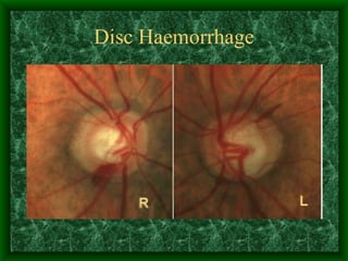 Disc Haemorrhage 